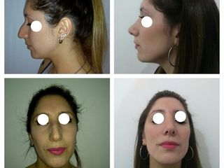 Rinoplastia