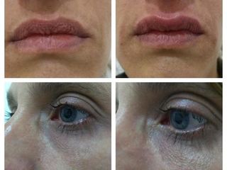 Relleno de labios y surco de ojeras