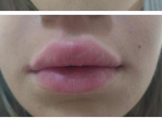 Aumento de labios