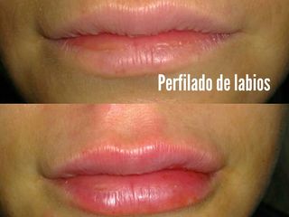 Relleno de Labios