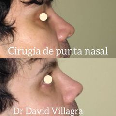 Rinoplastia - Dr. David Villagra