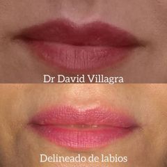 Relleno de labios - Dr. David Villagra