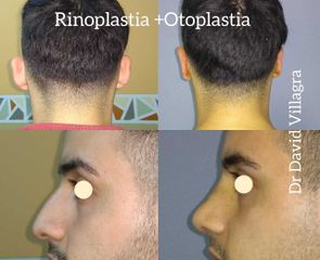 Rinoplastia + Otoplastia - Dr. David Villagra