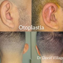 Otoplastia - Dr. David Villagra