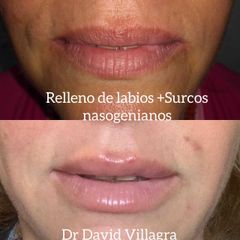 Relleno de labios - Dr. David Villagra