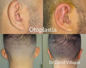 Otoplastia - Dr. David Villagra