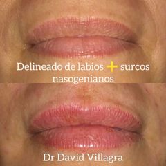 Relleno de labios - Dr. David Villagra