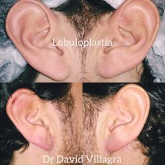 Lobuloplastia - Dr. David Villagra