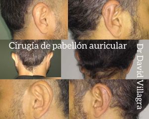 Otoplastia - Dr. David Villagra