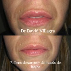 Relleno de labios - Dr. David Villagra