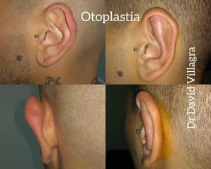 Otoplastia - Dr. David Villagra