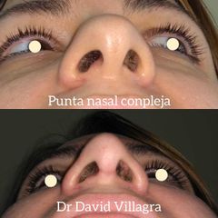 Rinoplastia - Dr. David Villagra