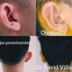 Otoplastia - Dr. David Villagra