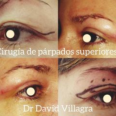 Blefaroplastia - Dr. David Villagra