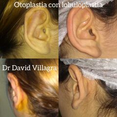 Otoplastia - Dr. David Villagra