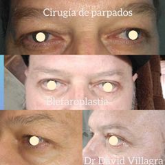 Blefaroplastia - Dr. David Villagra