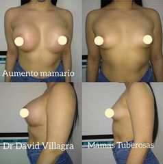 Aumento mamas - Dr. David Villagra