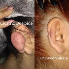 Queloide - Dr. David Villagra