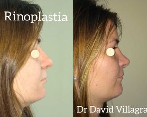 Rinoplastia - Dr. David Villagra