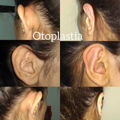 Otoplastia - Dr. David Villagra