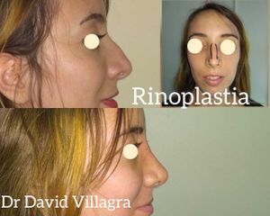 Rinoplastia - Dr. David Villagra