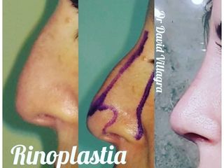 Rinoplastia - Dr. David Villagra