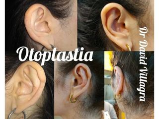 Otoplastia - Dr. David Villagra