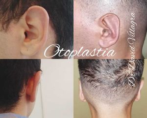 Otoplastia - Dr. David Villagra