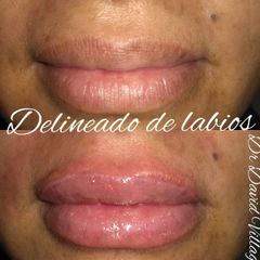 Relleno de labios - Dr. David Villagra