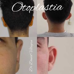 Otoplastia - Dr. David Villagra