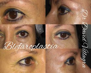 Blefaroplastia - Dr. David Villagra