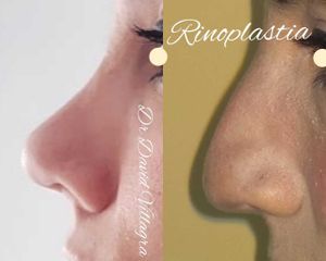 Rinoplastia - Dr. David Villagra