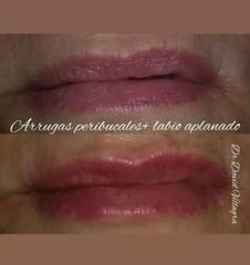 Relleno de labios - Dr. David Villagra