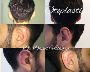 Otoplastia - Dr. David Villagra