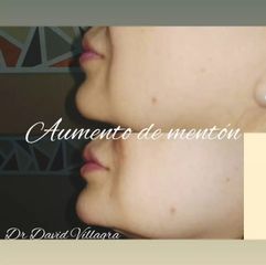 Rellenos faciales - Dr. David Villagra