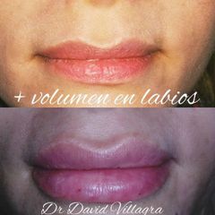 Relleno de labios - Dr. David Villagra