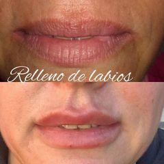 Relleno de labios - Dr. David Villagra