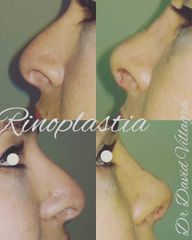 Rinoplastia - Dr. David Villagra