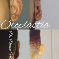 Otoplastia - Dr. David Villagra