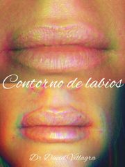 Contorno de labios - Dr. David Villagra