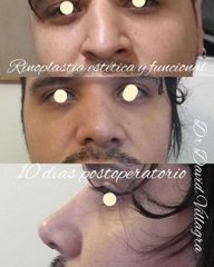 Rinoplastia - Dr. David Villagra