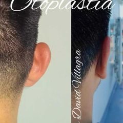 Otoplastia - Dr. David Villagra