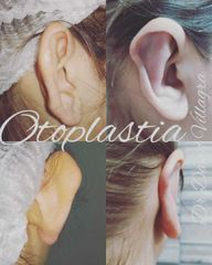 Otoplastia - Dr. David Villagra