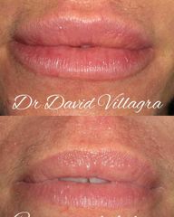 Relleno de labios - Dr. David Villagra