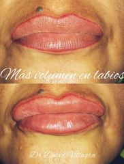 Relleno de labios - Dr. David Villagra