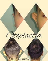 Otoplastia - Dr. David Villagra