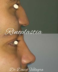 Rinoplastia - Dr. David Villagra