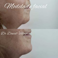 Rellenos faciales - Dr. David Villagra