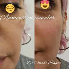 Rellenos faciales - Dr. David Villagra