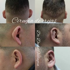 Otoplastia - Dr. David Villagra